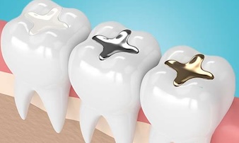 seminole Dental composite filling service