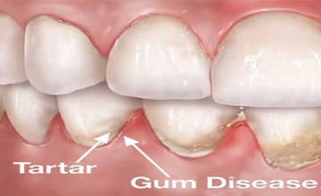 Seminol Dental Periodontal (Gum) Disease service