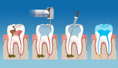 Seminol Dental Endodontics Therapy service