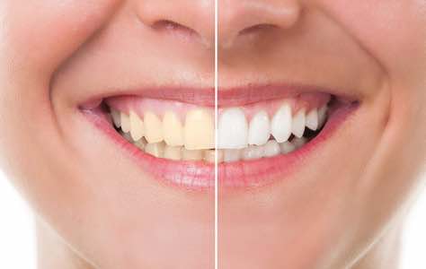 Seminol Dental Teeth Whitening service